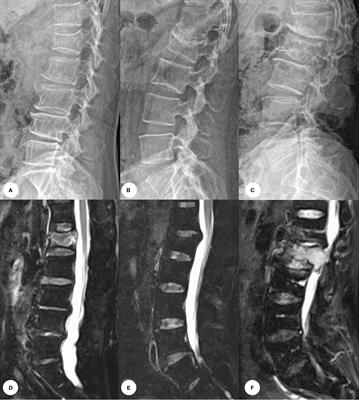 Deep learning-based artificial intelligence model for classification of vertebral compression fractures: A multicenter diagnostic study